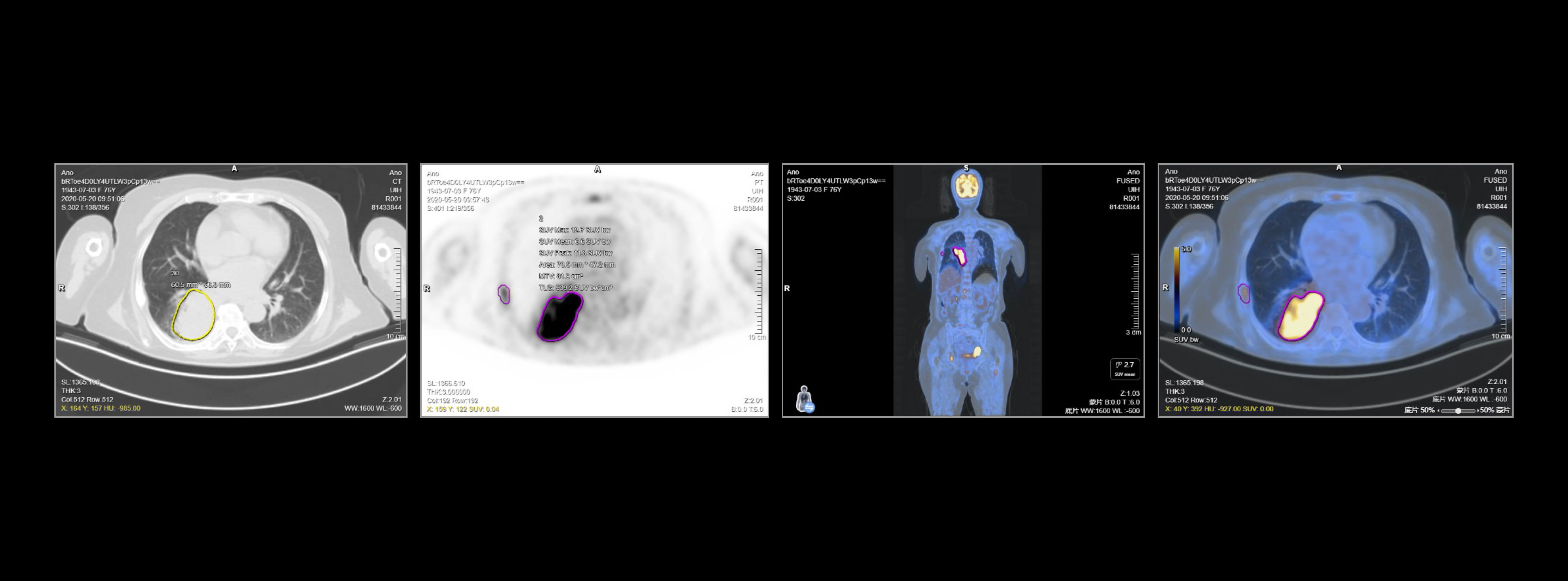 跨模态影像智能配准融合，病灶自动分割并提供多参数定量分析