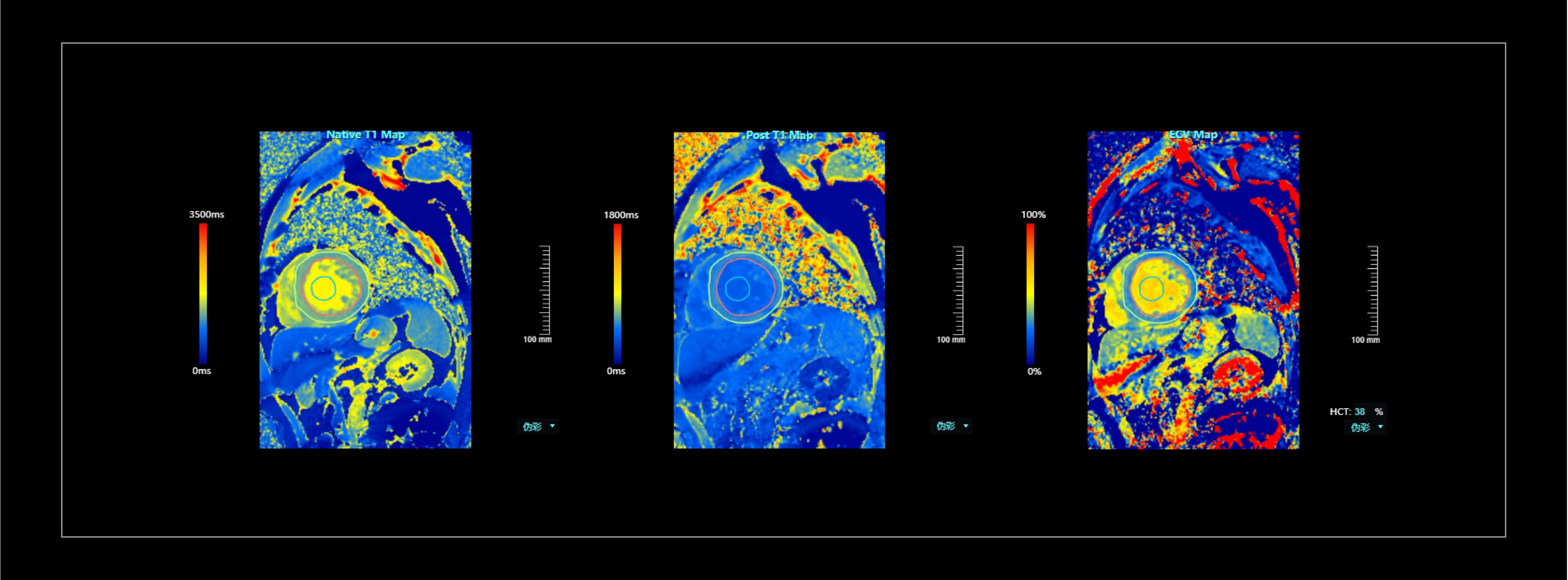 T1 mapping心肌组织特征定量分析