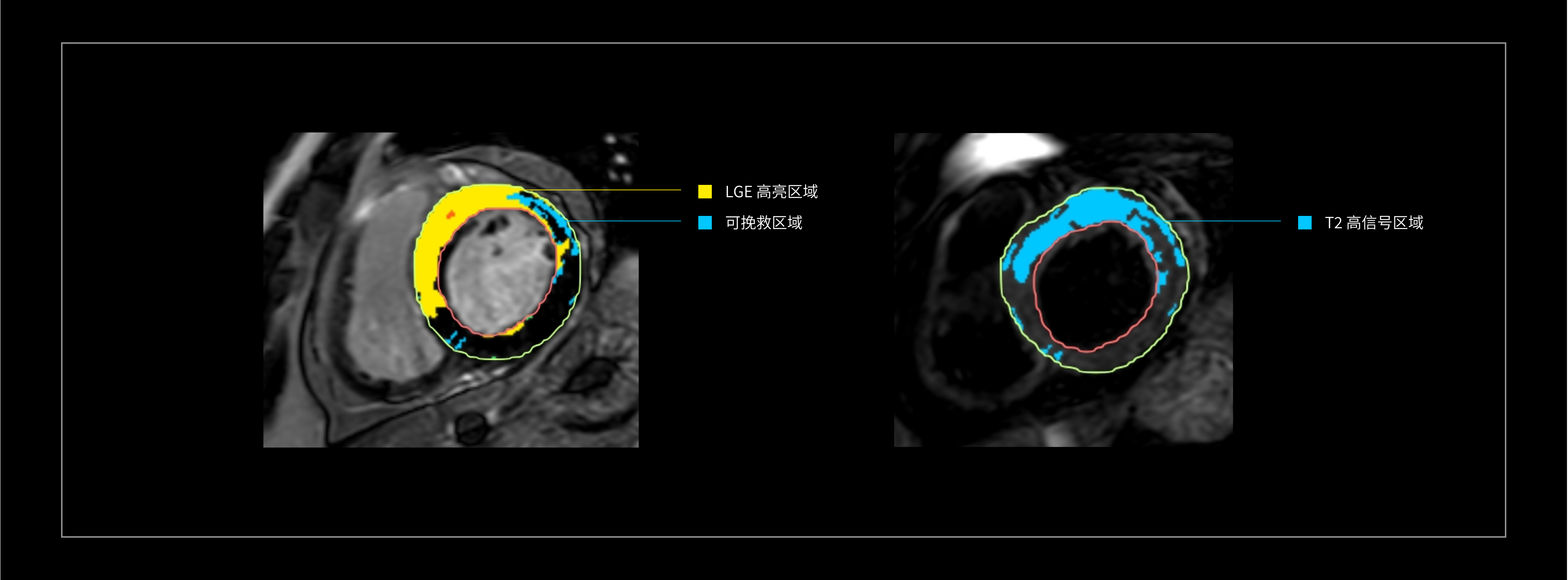 LGE/T2W高信号区域计算及自动分析