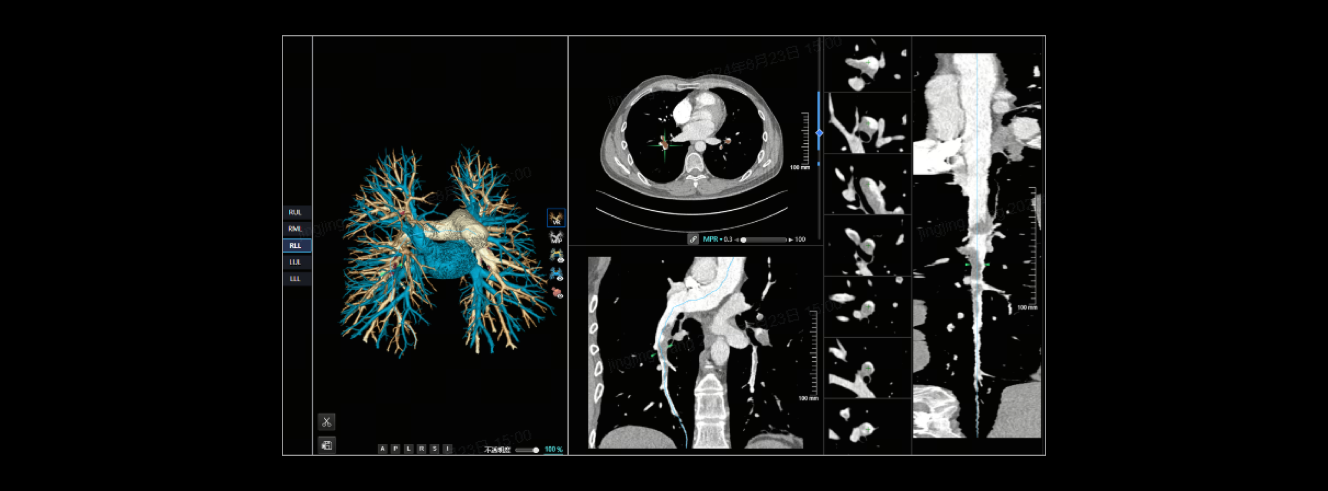 肺血管多种重建视图