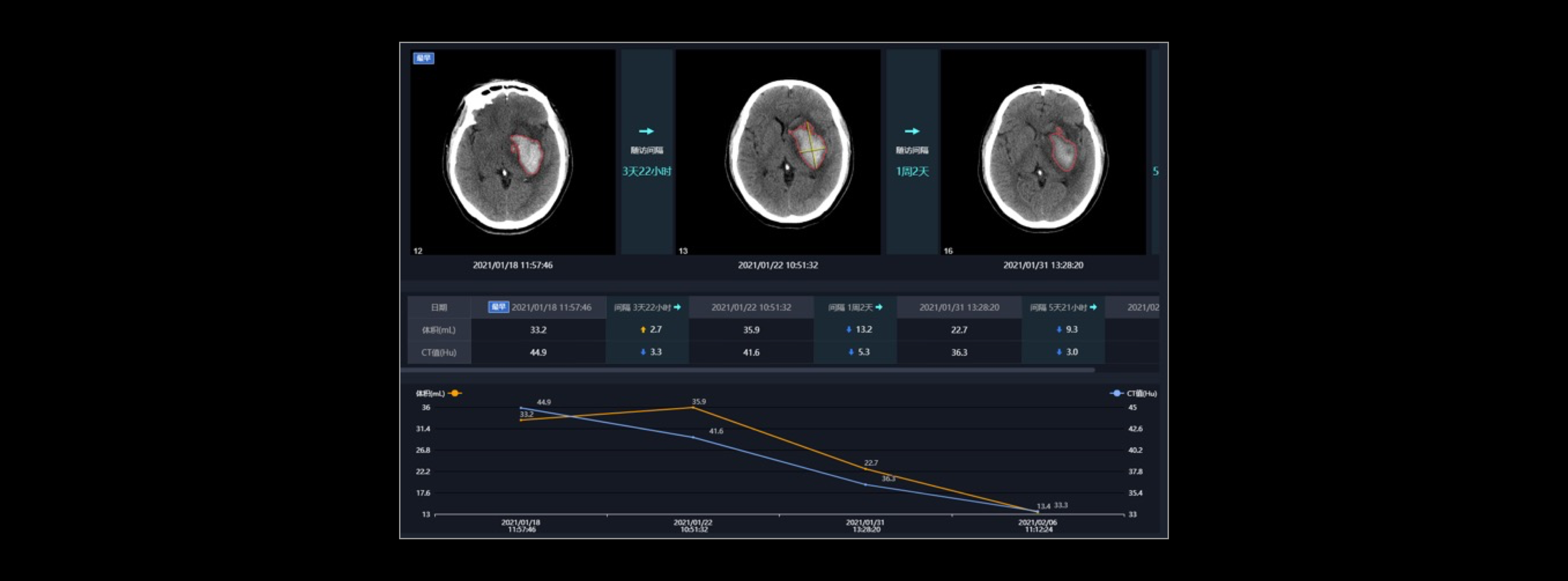 全病程随访：随访可视化，直观评估血肿发展情况和治疗效果