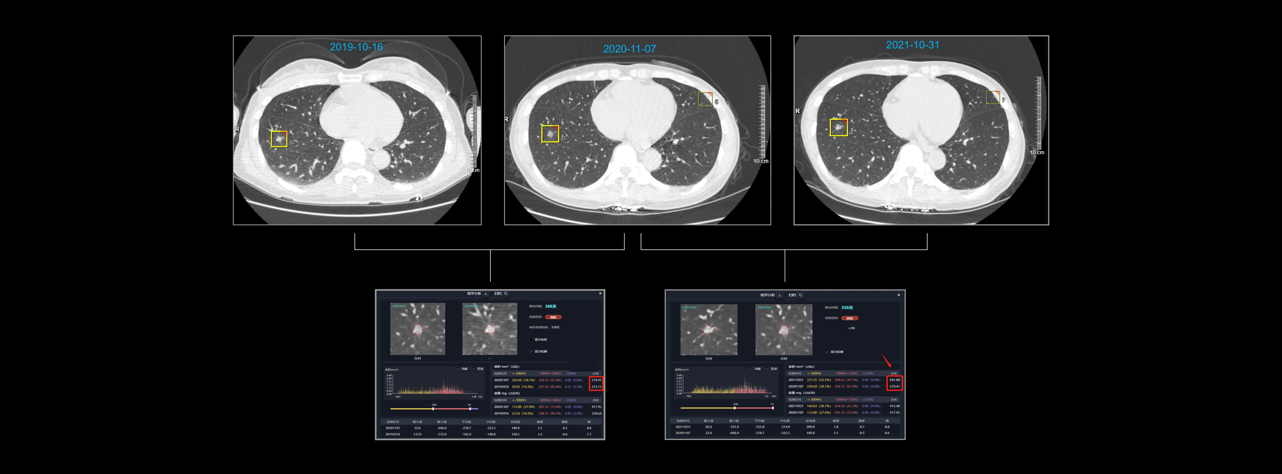 AI显示结节体积增大，且倍增时间符合肿瘤生长特性，病理结果为浸润性腺癌
肺结节随访分析助力浸润性腺癌诊断