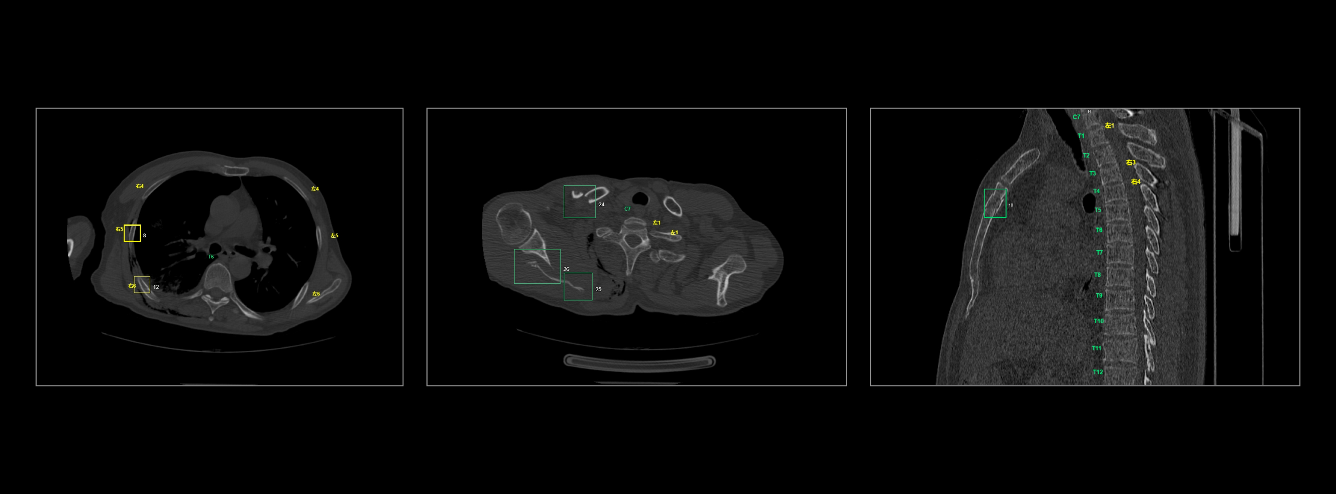 自动标记肋骨、椎骨的位置标签，精准检出肋骨、椎骨、锁骨、肩胛骨、胸骨骨折