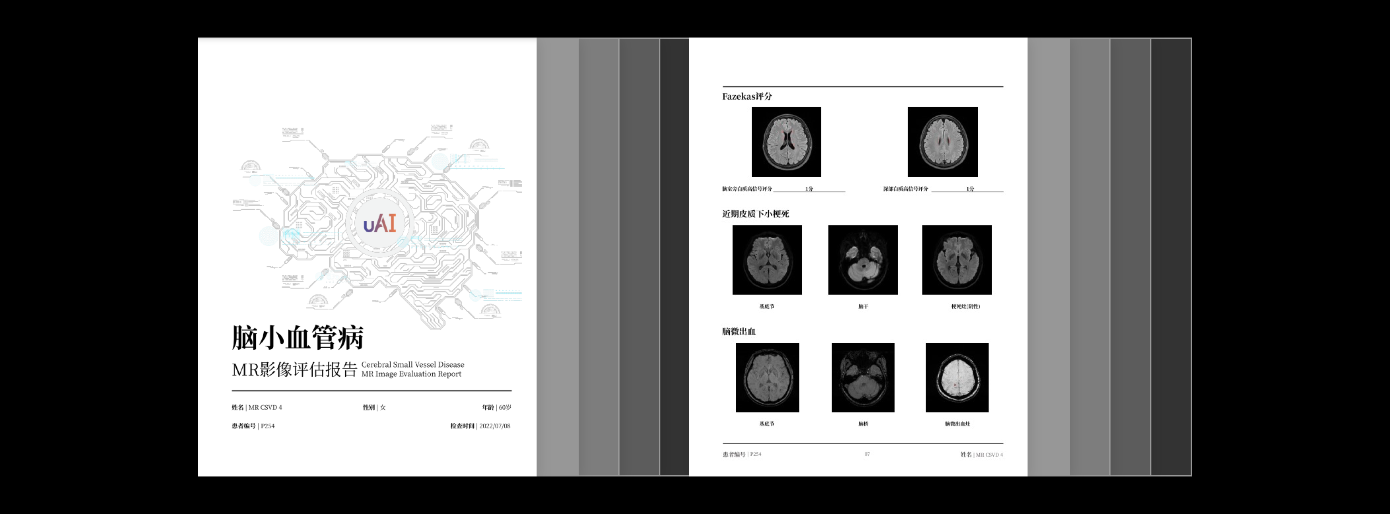 脑小血管病影像评估报告