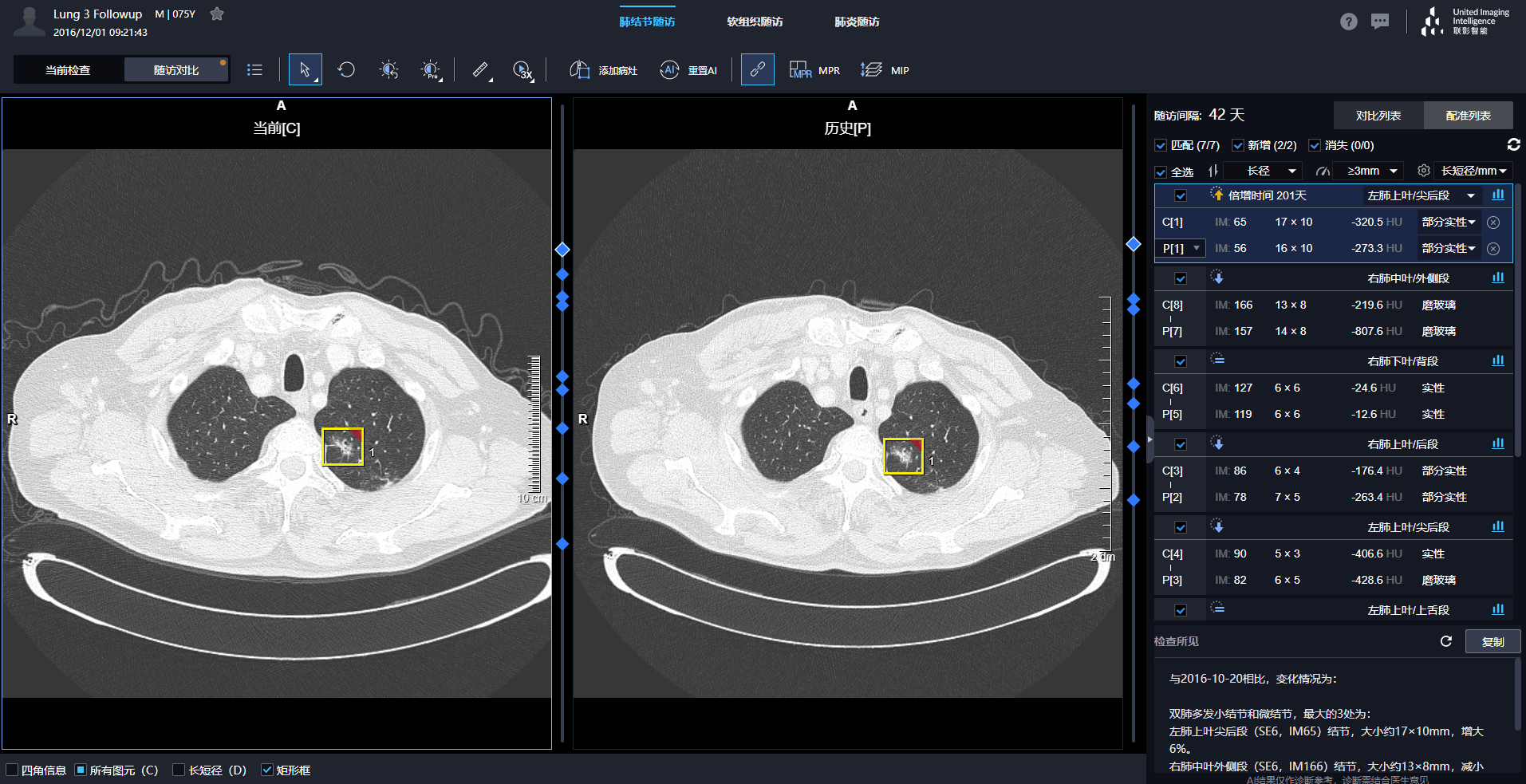 一键配准，联影智能肺结节人工智能随访管理系统智能追踪结节生长变化