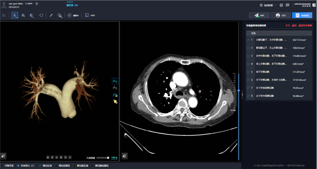 肺栓塞诊治刻不容缓，联影智能CTA肺栓塞AI人工智能分析系统提效诊疗流程