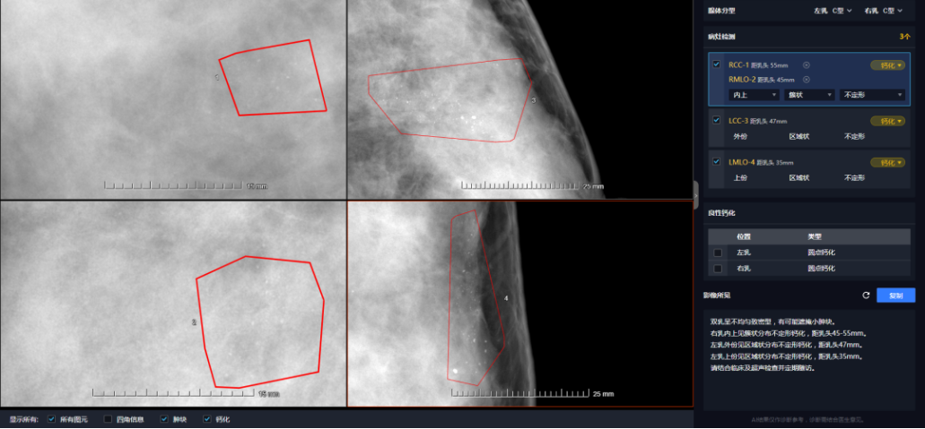 联影智能多模态乳腺AI人工智能分析系统赋能临床，覆盖乳腺影像全工作流