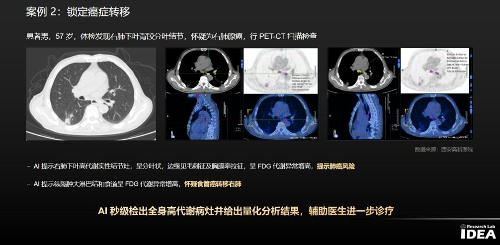 联影智能PET/CT AI人工智能分析系统临床价值显著，助力精准诊疗