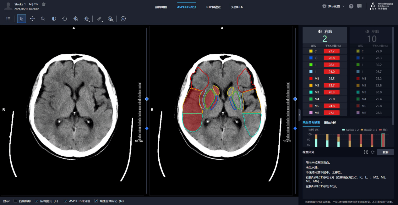 脑缺血AI人工智能诊断软件：实现脑缺血患者的自动 ASPECTS 评分