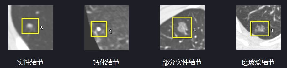 练就“火眼金睛”：联影智能肺结节人工智能辅助诊断系统提高临床阅片质效