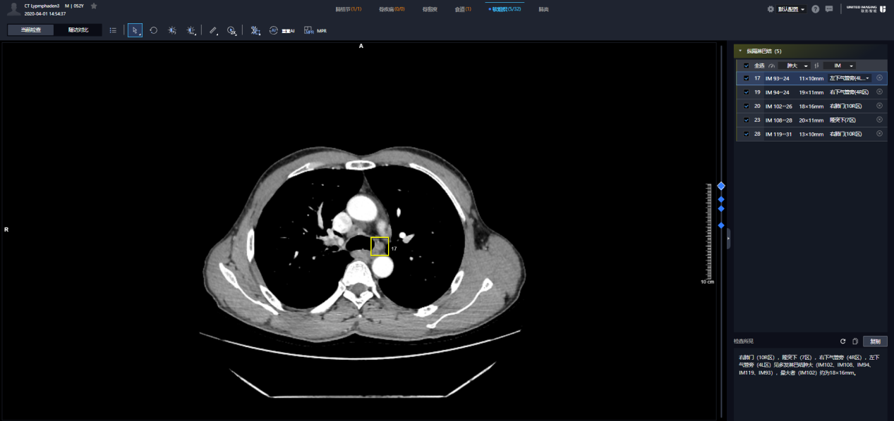 联影智能CT淋巴结AI人工智能分析系统，攻克传统诊疗痛点