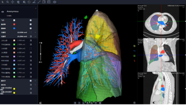 联影智能将AI技术应用于胸部平扫三维重建，助力精准诊疗