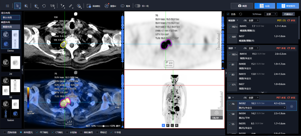 联影智能推出PET/CT AI人工智能分析系统，赋能核医学发展