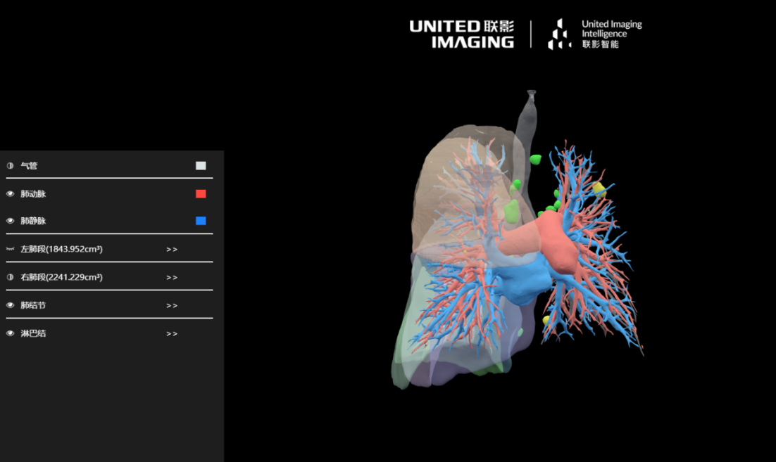 联影智能胸部CT三维重建系统能为诊疗带来哪些改变？