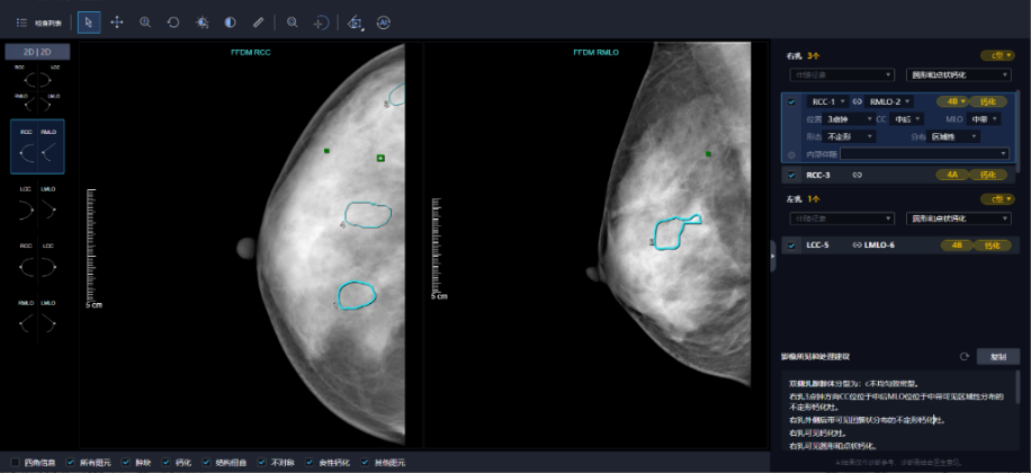联影智能乳腺AI人工智能分析系统助力乳腺癌早筛